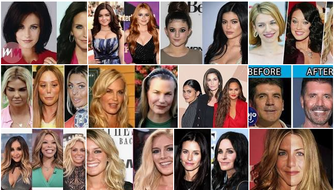 Celebrities Plastic Surgery