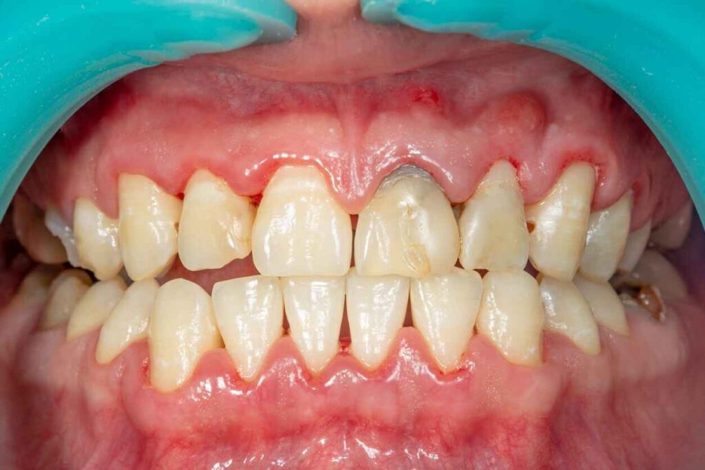 how long can you keep your teeth with periodontal disease