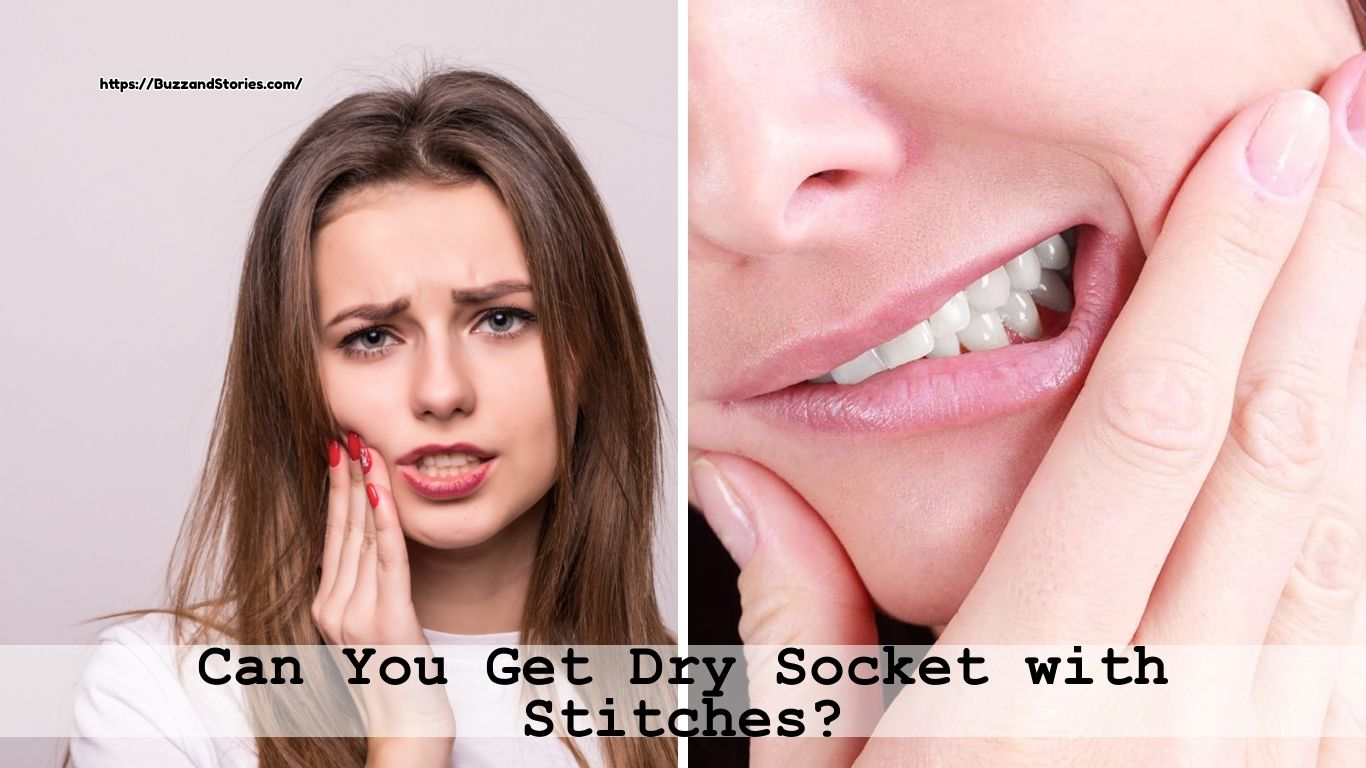 Can You Get Dry Socket with Stitches?